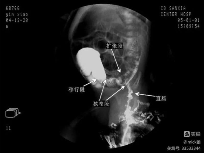 女子在家自行灌肠引发水中毒，警惕健康自救变危机