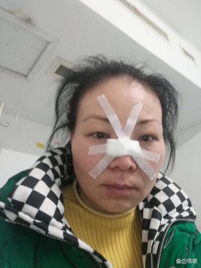 女子鼻骨骨折消肿后喜提高鼻梁，重塑自信美丽之路